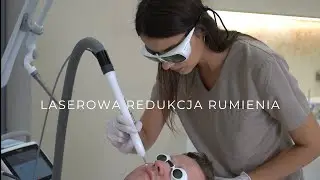 Laserowa redukcja rumienia - jak wygląda zabieg?