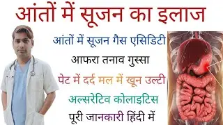 आंतों में सूजन के कारण लक्षण इलाज Ulcerative Colitis Ka Lakshan Treatment Ibd review Hindi