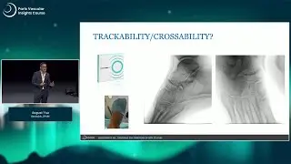Shockwave IVL: cracking the barriers of below-the-knee disease - PVI 2025