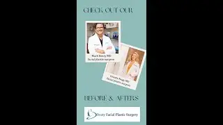 Facelift Before and After