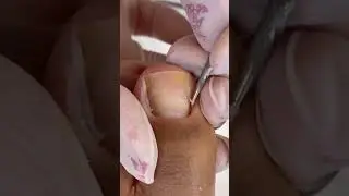 EP 03, Bad Toenail #toenails #feet #toes #prettytoes #nails #footcare #cutefeet #cutetoes #toerings