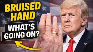 Trump&rsquo;s Bruised Hand Caught on Camera &mdash; Doctors and Critics React