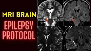 MRI Brain Epilepsy protocol planning