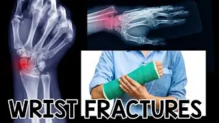 Understanding Wrist Fractures: Causes, Treatments & Essential Protective Gear for High-Impact Sports