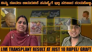 ₹10/- BEST PRICE IN KARNATAKA FOR HAIR TRANSPLANT AND BEARD TRANSPLAT || HSN HAIR TRANSPLANT