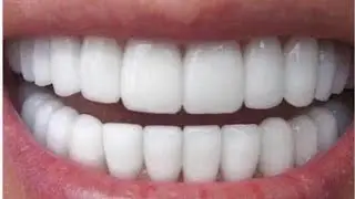 SHINY SMILE VENEERS| 🚨DO NOT DO THIS 🙅🏽‍♀️