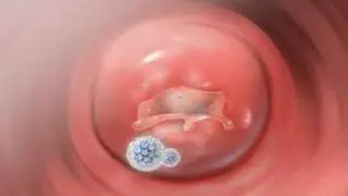 HPV