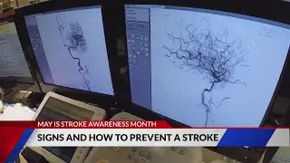 Signs and how to prevent a stroke