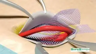 AMID Stapler&reg; Instructional Animation Video