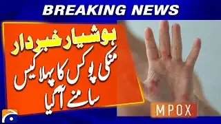 1st Confirmed case of M-Pox Emerges in Karachi | Breaking News