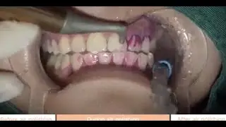 AP A,  Dental Air Polisher In Action!