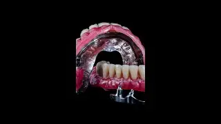 Is there a metallic taste from the implant's titanium bar?