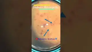 Diabetic retinopathy | Hemorrhages | cotton wool spots | Hard exudates | Fundus | Short Video 164