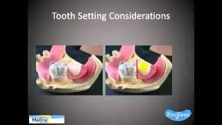 E Gasket technique video