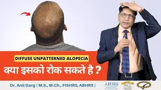 Diffuse Unpattern Hair Loss - क्या इसको रोक सकते है ? | Hair Loss Treatment Dr. Anil Garg