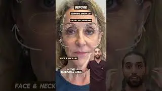A 6-Week Facial Rejuvenation Journey