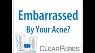 Clearpores-Pores & Scar Removal Treatment Review