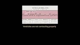 nursing exam hack- ecg changes in ventricular Fibrillation #rrb ,#norcetmcq ,#mhsrb
