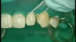 Ceram X duo Diastema Dr. B.Klaiber /1