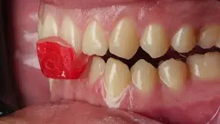 Окклюзионная шина I: запись центрального соотношения