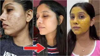 Remove dark spots, acne scars, pimples  || Budget Indian skincare ✨ 7 days challenge