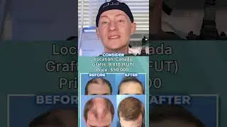$1,000 vs $50,000 Hair Transplant