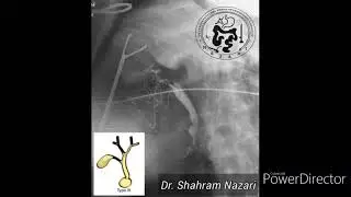 Choledochal cyst type III