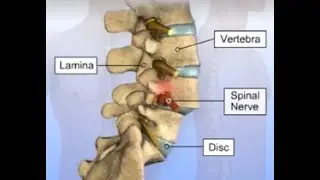 SPONDYLO listhesis