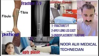 Fracture tibia fabula,,, undisplacement fracture, aply long leg cast,