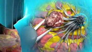 Learn about lumpectomy