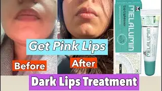Melalumin Lip Lightening Cream Review Dark Lips/Pigmented Lips Treatment #darklips #darklipstreat...