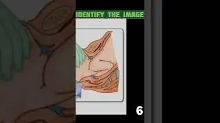 #Norcet #Image based question #OBG #AIIMS NORCET