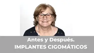 Antes y Después de implantes cigomáticos