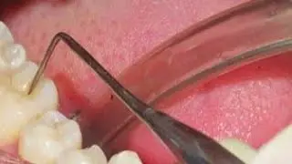 Methods Of Diagnosis of Dental Caries