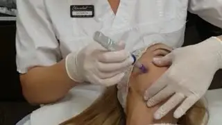 Microneedling, terapie inductoare de colagen propriu #mezopen