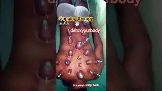Cupping therapy for detoxyourbody #cupping #cuppingtherapy #detoxyourbody #youtubeshorts #ytshorts