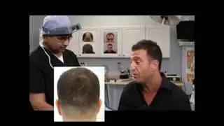 Before and After Artas Hair Transplant Client Review | 416 747-7873