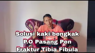 SESI 13 : Tips mengatasi bengkak P.O pasang Pen Fraktur Tibia Fibula
