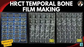 HRCT Temporal Bone Filming Process - Lecture:20 (Part-03)| Tutorial-40 | HRCT of Petromastoid region