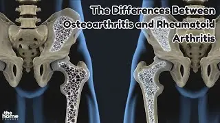 Understanding the Differences Between Osteoarthritis and Rheumatoid Arthritis