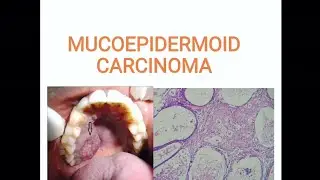 Mucoepidermoid carcinoma #oral cancer @verrucous carcinoma 