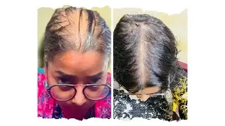 Self Loved Ayesha is live Now Cure All Types Of Hair Problems Like Baldness Hairfall Hair Thinning👍