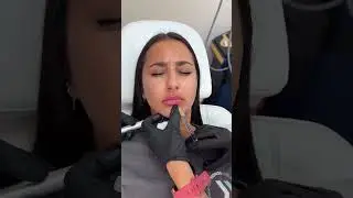 Lip augmentation is not only about beauty | Elite Medical SPA | Anti-Ageing Treatments