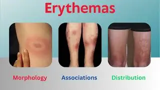 Erythemas Uncovered: Insights into Morphology, Associations, and Distribution