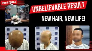 Incredible Body Hair Transplant for Severe Baldness | Dr. Abhinav Kumar's Expert Case