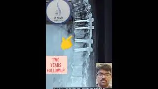 spondylodiscitis with prevertebral abscess