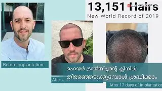 ഹെയർ ട്രാൻസ്പ്ലാന്റ് ക്ലിനിക് തിരഞ്ഞെടുക്കുമ്പോൾ ശ്രദ്ധിക്കേണ്ട കാര്യങ്ങൾ