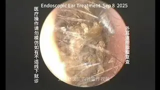 Review and cleaning of cholesteatoma and cerumen softening and cleaning 20250908