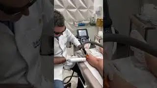 Tratamento de microvarizes com laser e escleroterapia.