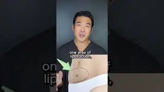 Biggest lipo regret? #medspa #filler #botox #plasticsurgery